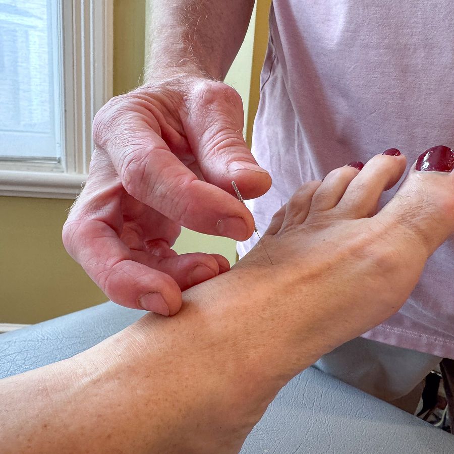 Mark performing acupuncture on a patient's foot
